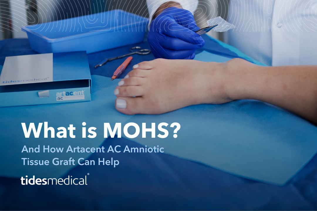 What is MOHS & How Artacent AC Amniotic Tissue Graft Can Help