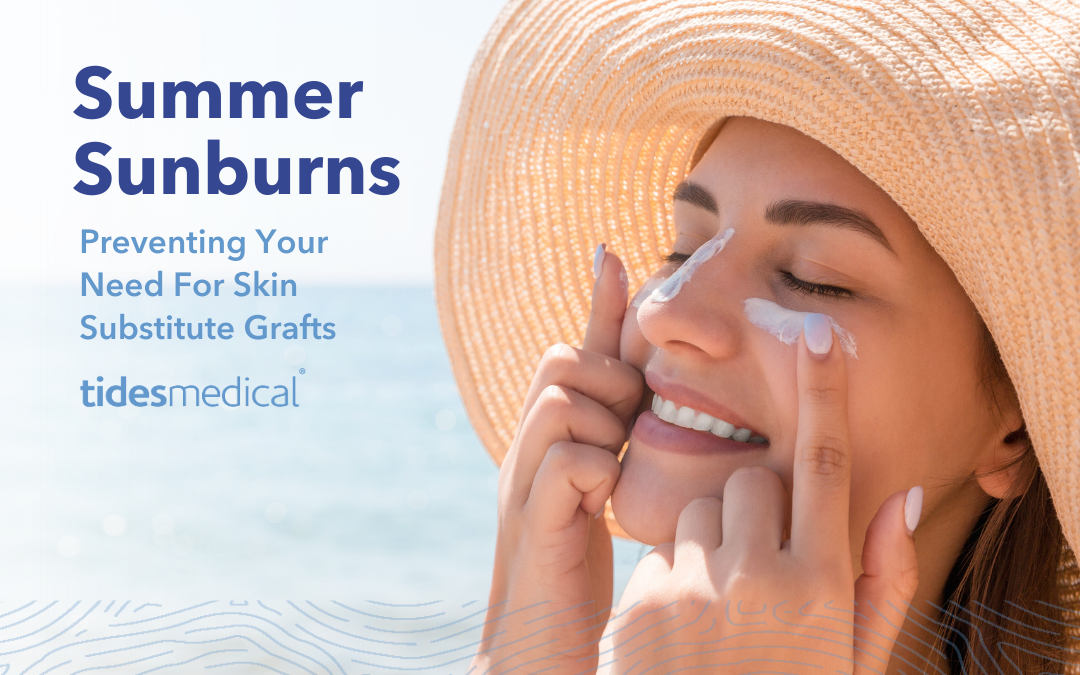 Summer Sunburns – Preventing Your Need For Skin Substitute Grafts