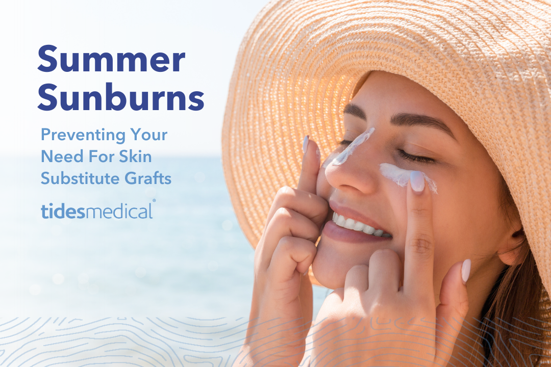 Summer Sunburns – Preventing Your Need For Skin Substitute Grafts